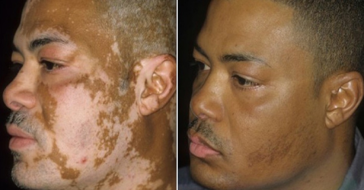 Cubanos desenvolvem cura contra vitiligo em 3 dias